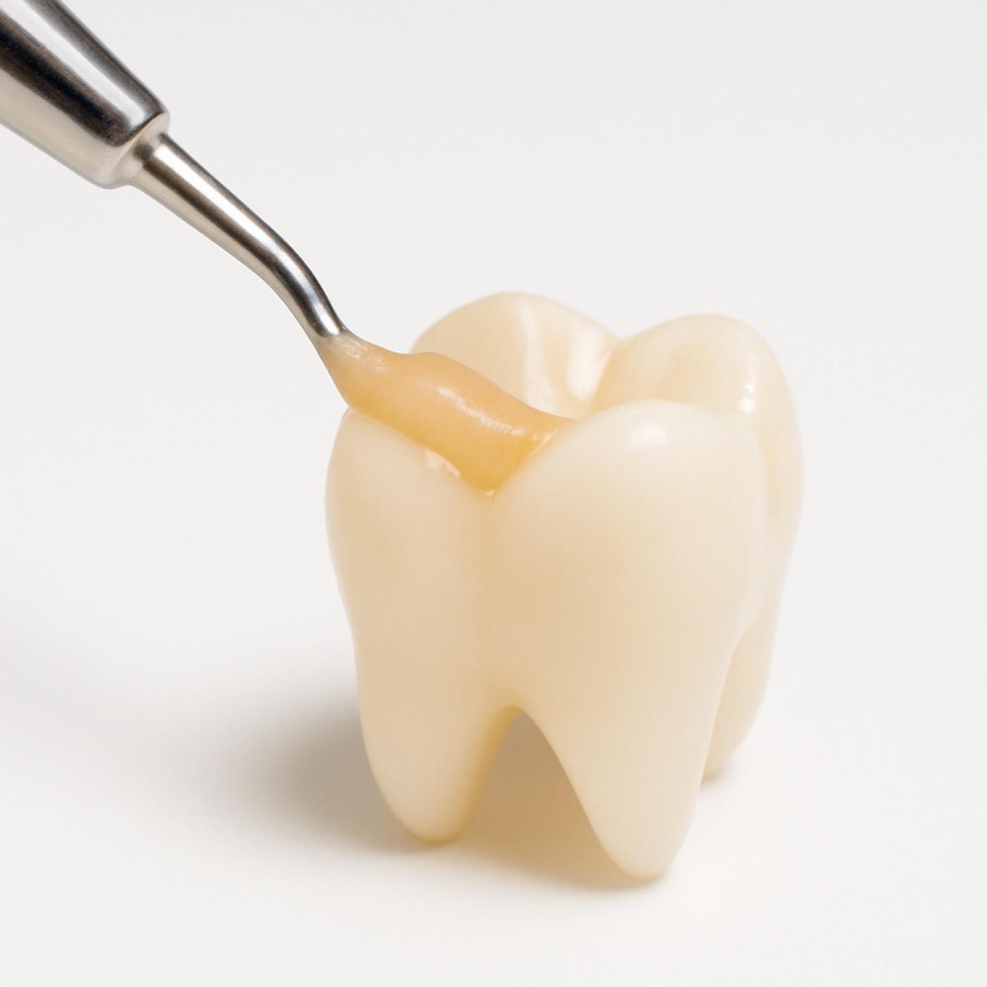 Tooth Bonding